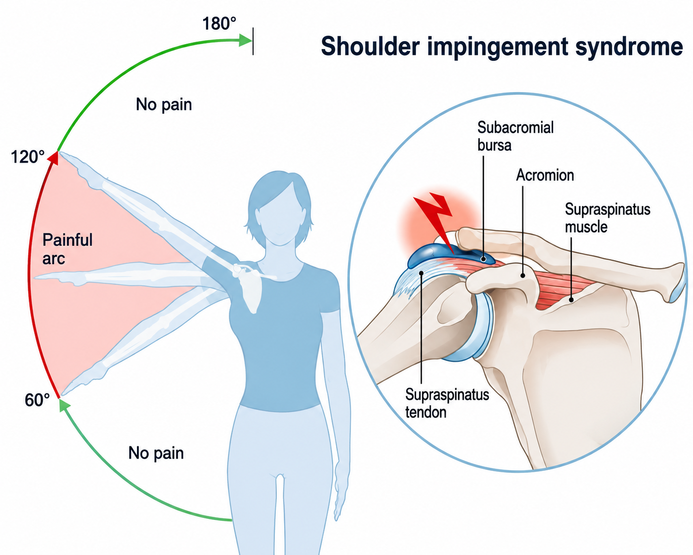Painful Arc Syndrome Overview